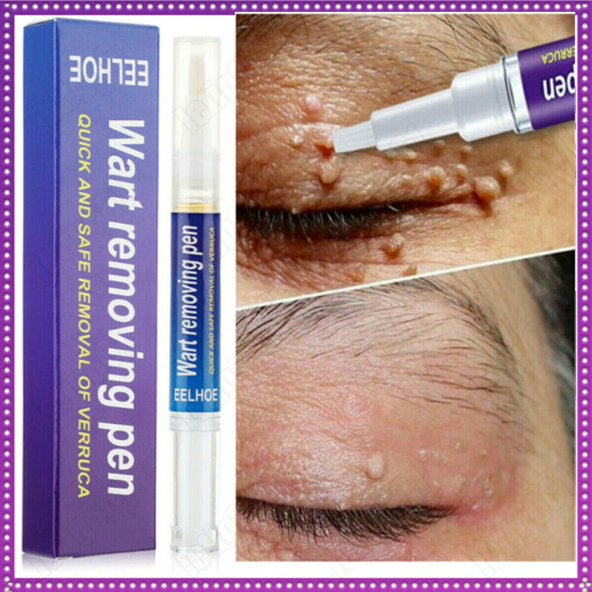Wart, Skin Tag, Mole Remover Pen - 12 Hours