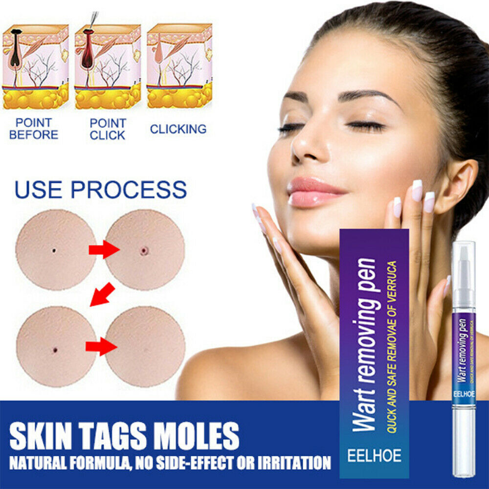 Wart, Skin Tag, Mole Remover Pen - 12 Hours