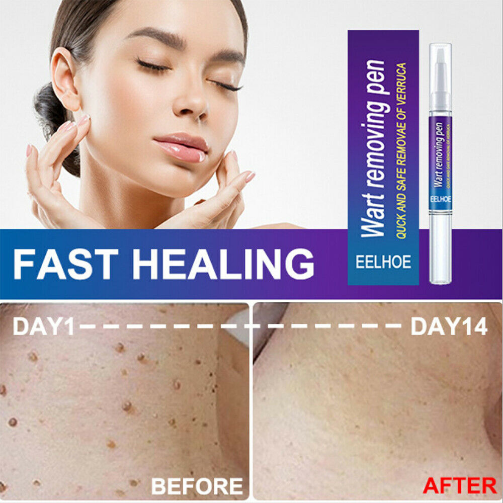 Wart, Skin Tag, Mole Remover Pen - 12 Hours