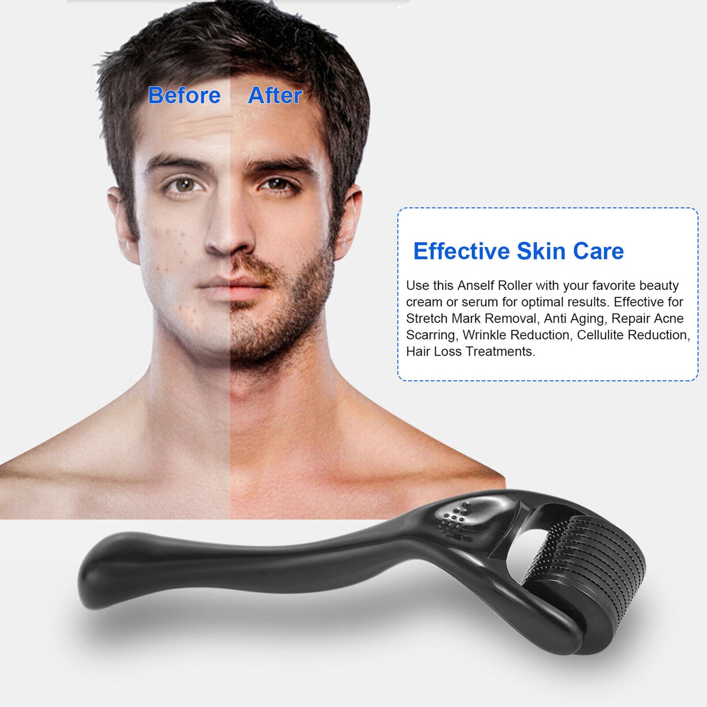 Titanium Microneedle Derma Roller
