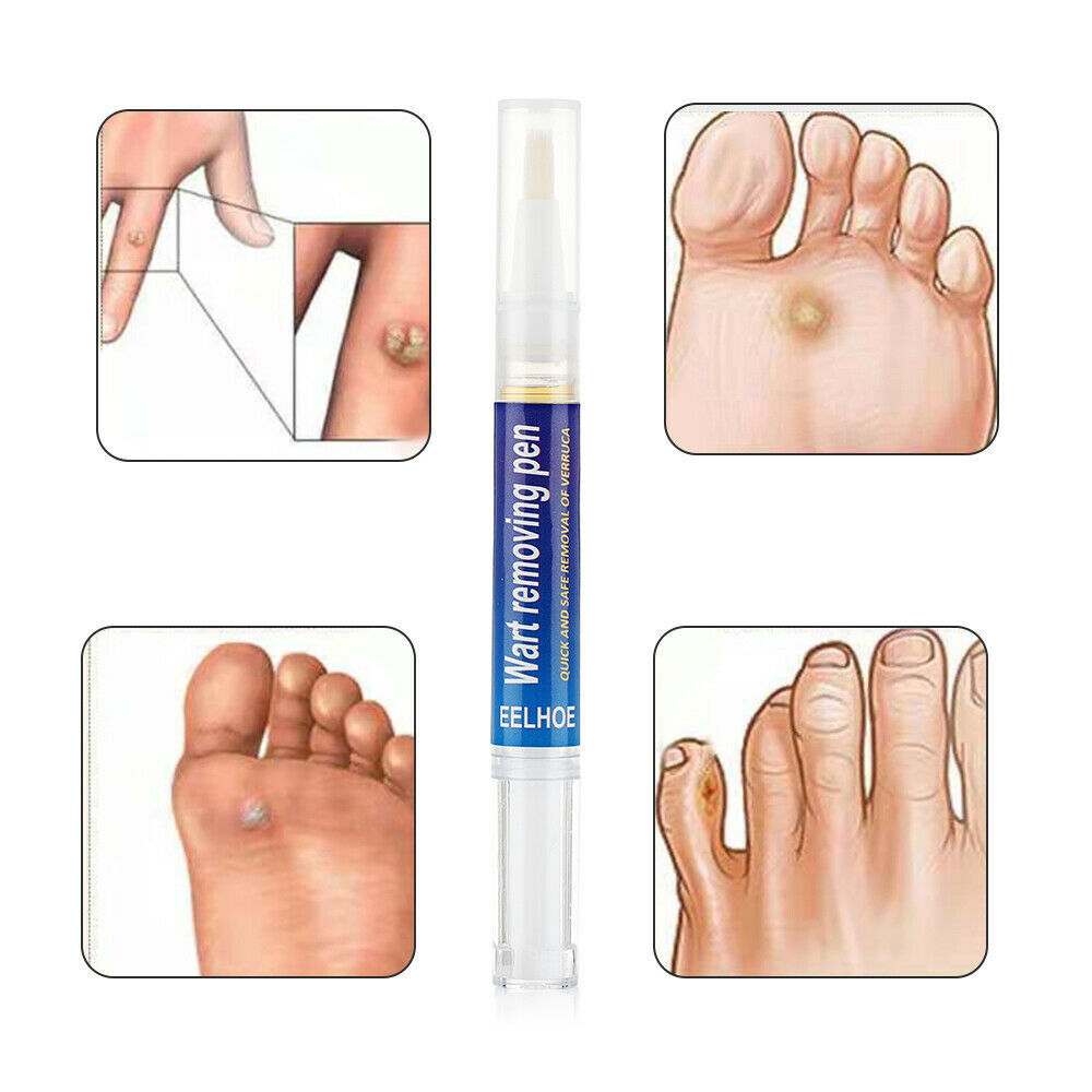 Wart, Skin Tag, Mole Remover Pen - 12 Hours
