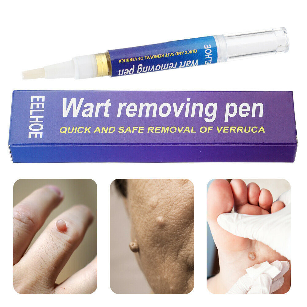 Wart, Skin Tag, Mole Remover Pen - 12 Hours