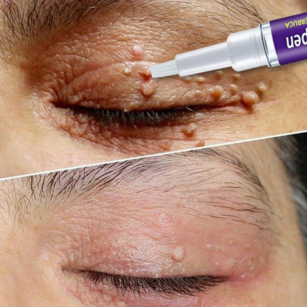 Wart, Skin Tag, Mole Remover Pen - 12 Hours
