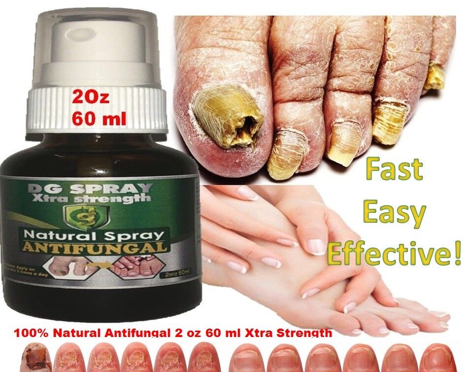 Antifungal Toenail Treatment