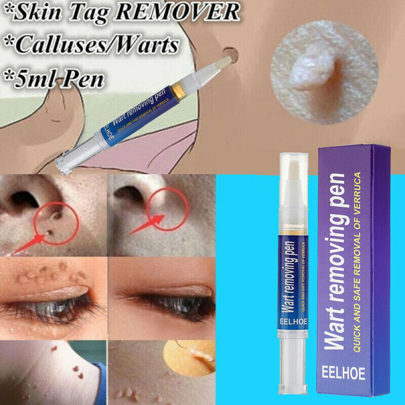 Wart, Skin Tag, Mole Remover Pen - 12 Hours