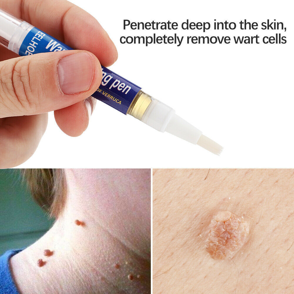 Wart, Skin Tag, Mole Remover Pen - 12 Hours