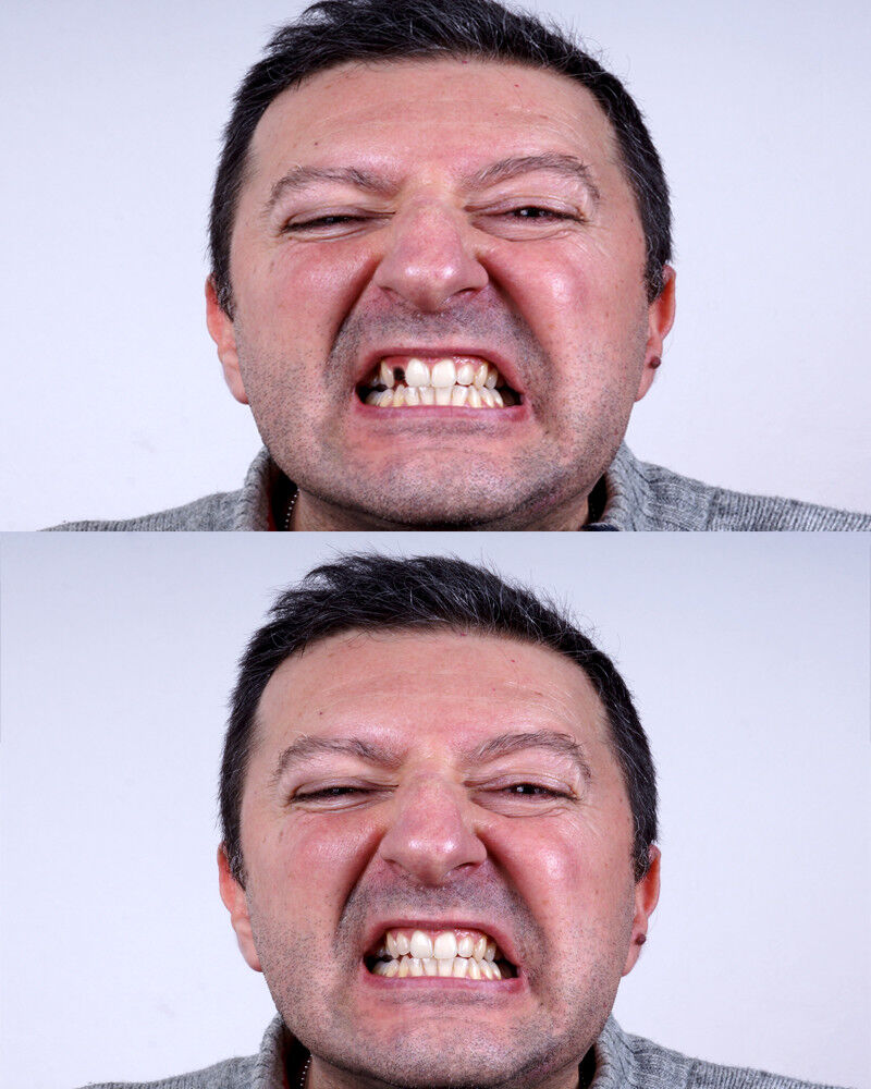 Temporary Tooth Replacement Kit