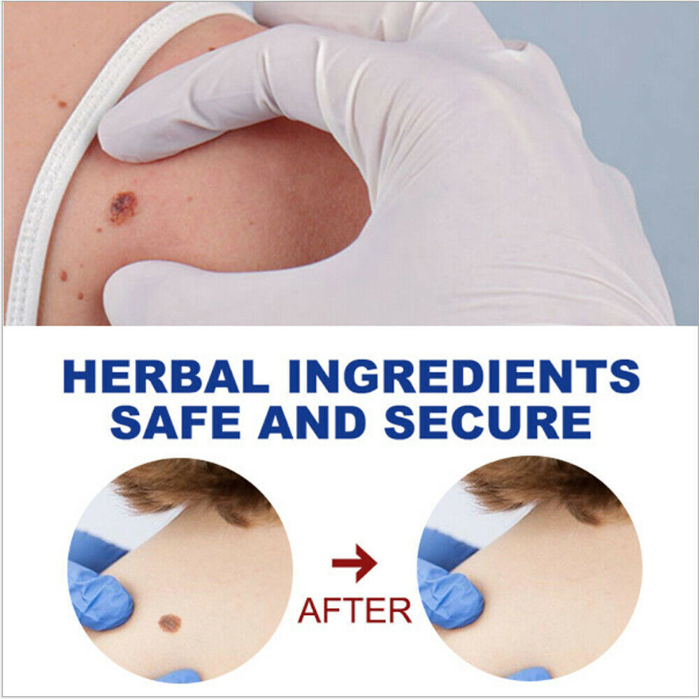 Wart, Skin Tag, Mole Remover Pen - 12 Hours