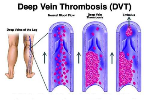 Compression Stockings - Varicose Vein Relief
