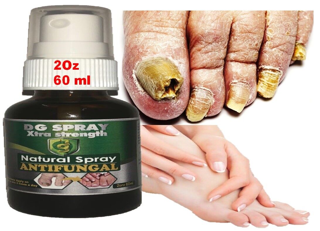 Antifungal Toenail Treatment