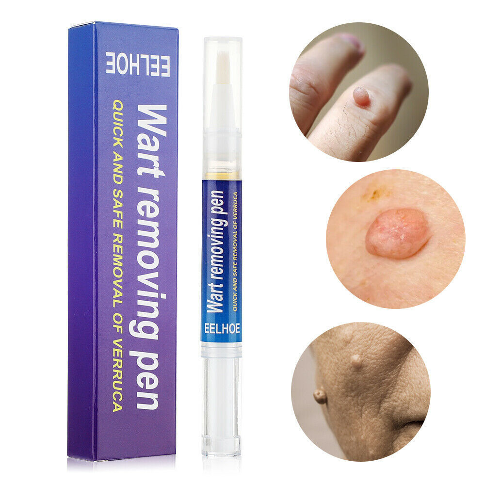 Wart, Skin Tag, Mole Remover Pen - 12 Hours