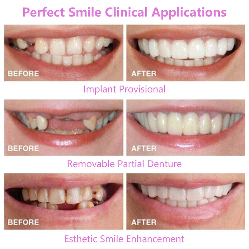 Snap On Upper & Lower False Teeth Covers