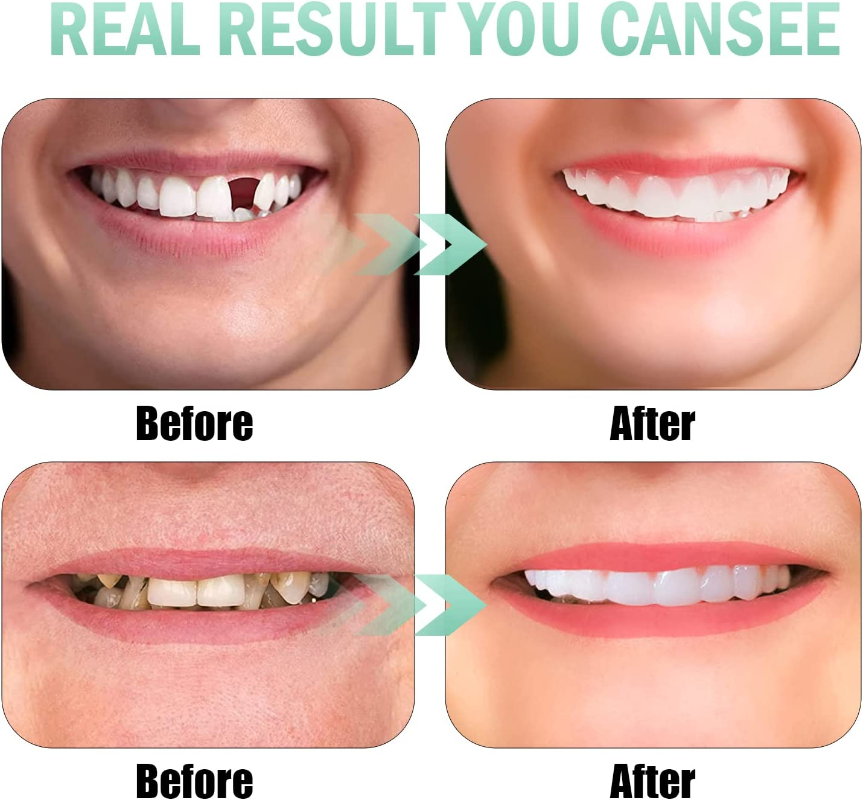 Snap On Upper & Lower False Teeth Covers